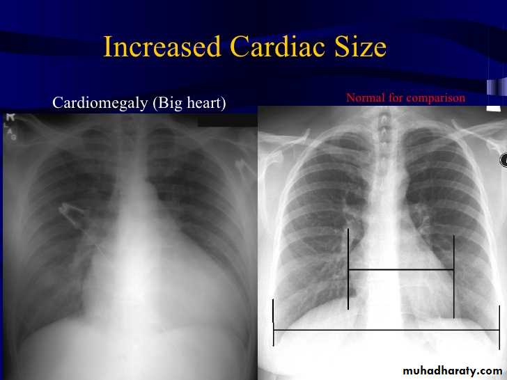 Mediastinum and heart