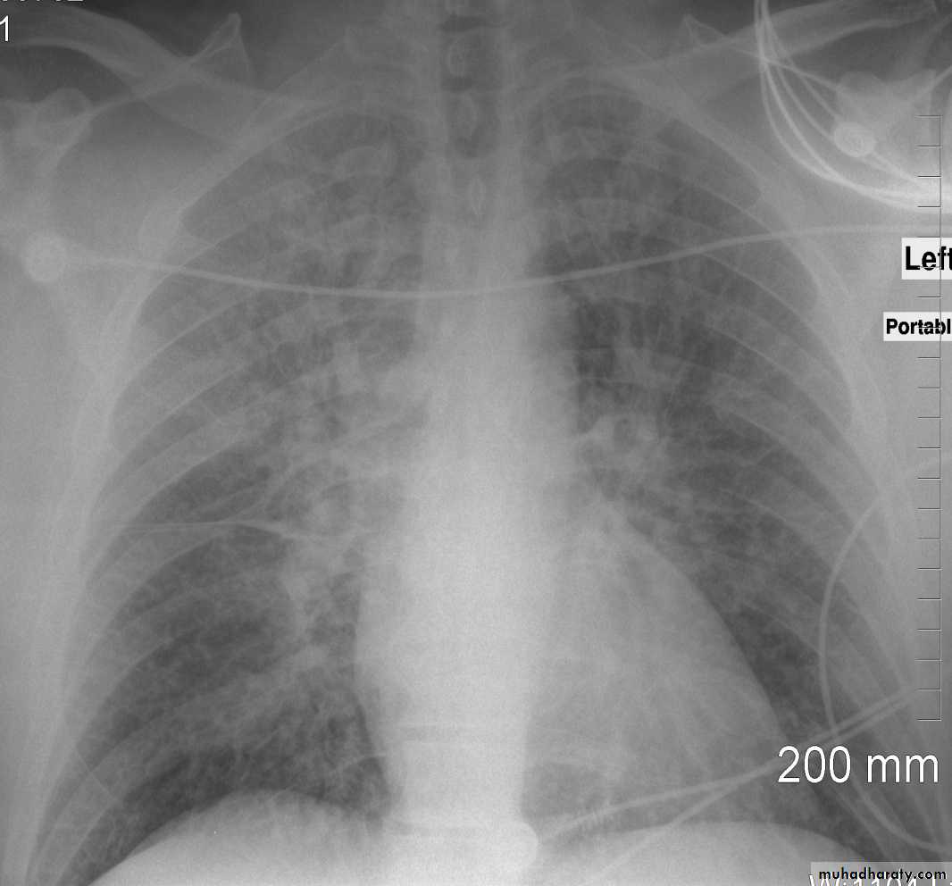 Mediastinum and heart