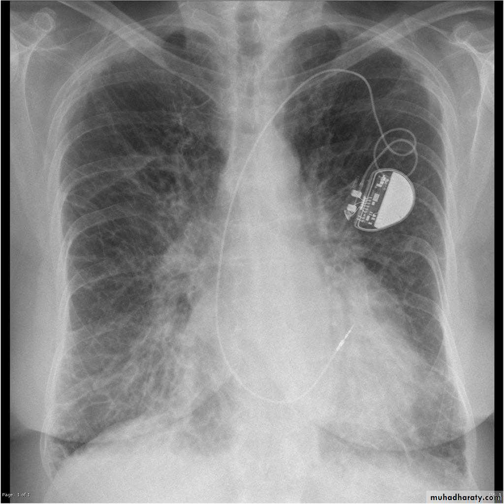 Mediastinum and heart