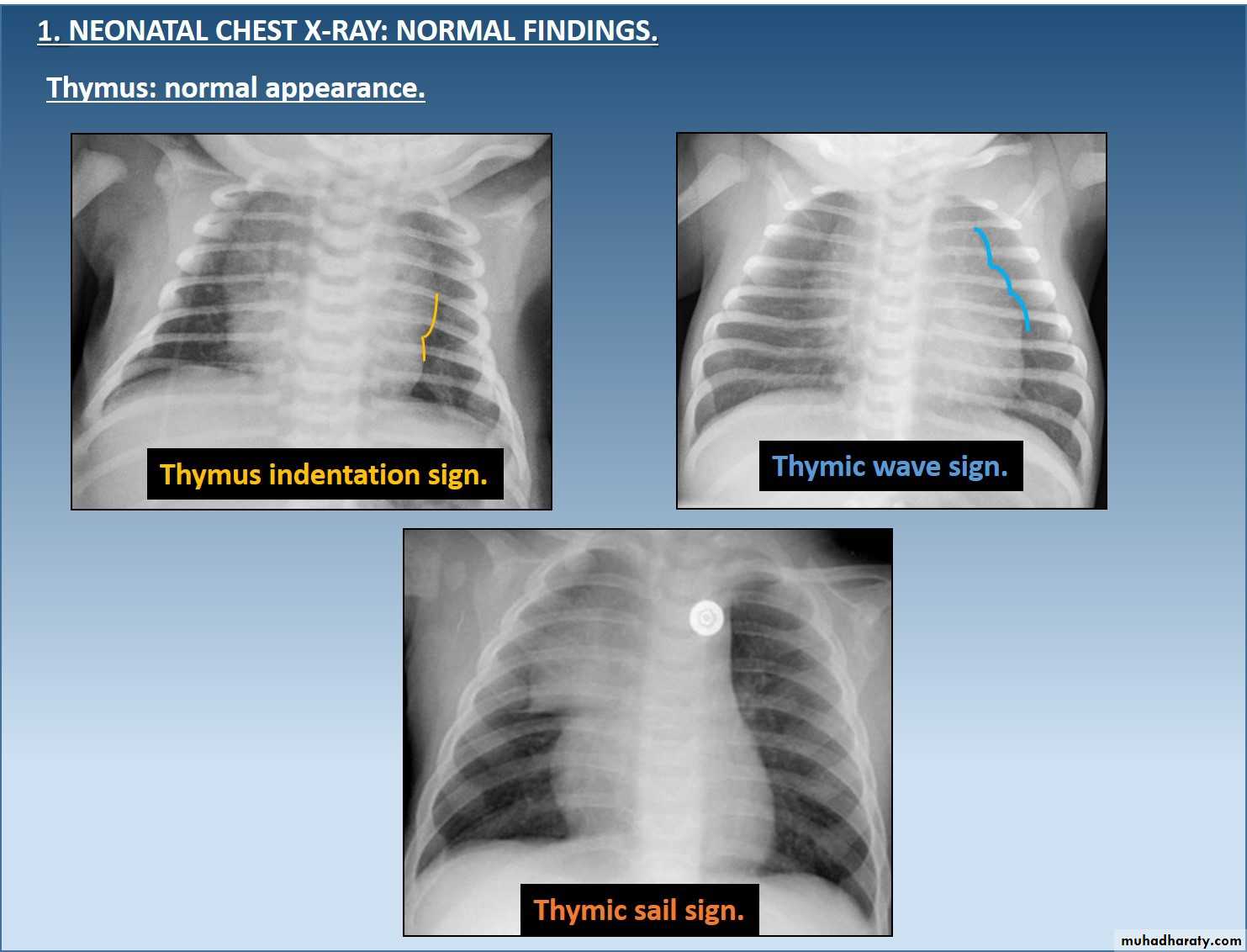 Mediastinum and heart