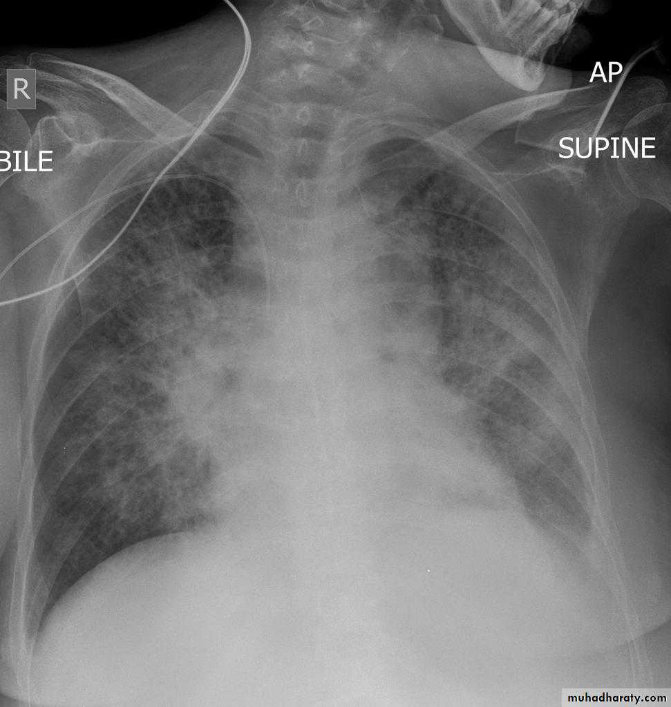 Mediastinum and heart