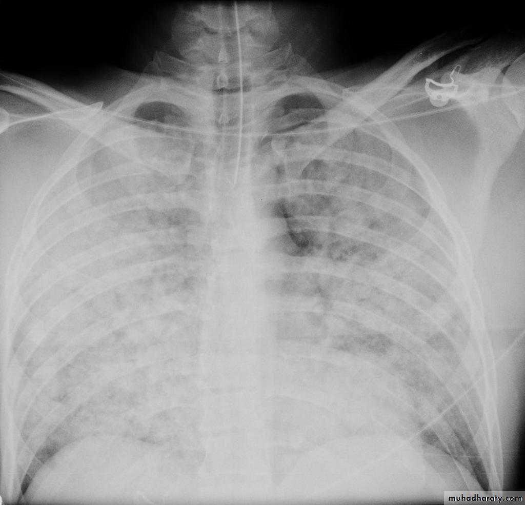 Mediastinum and heart