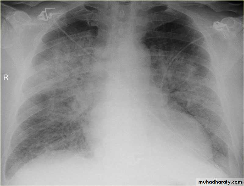 Mediastinum and heart