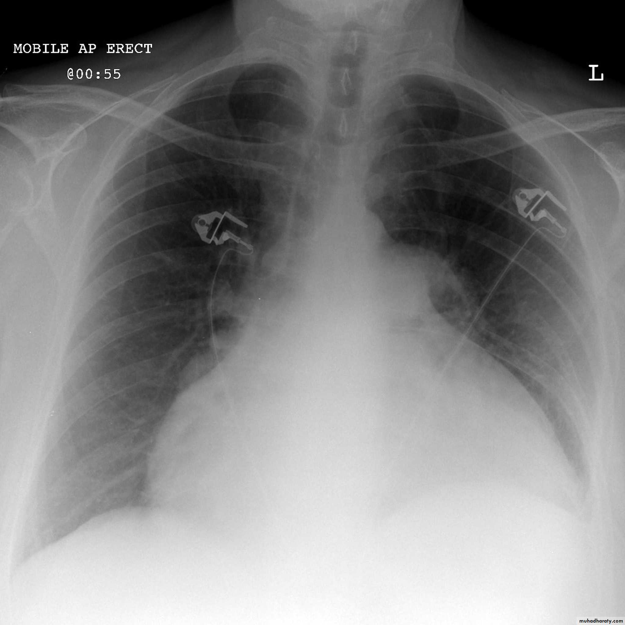 Mediastinum and heart