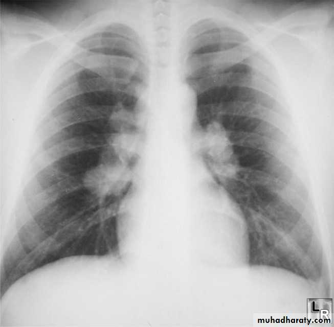 Mediastinum and heart