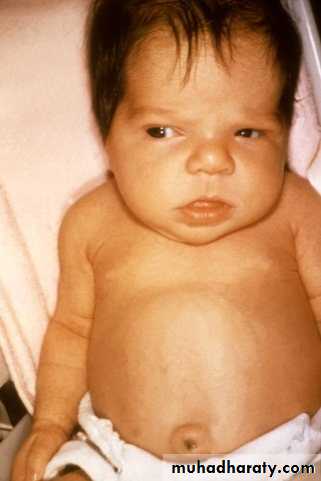 conjenital hypothyrodysm