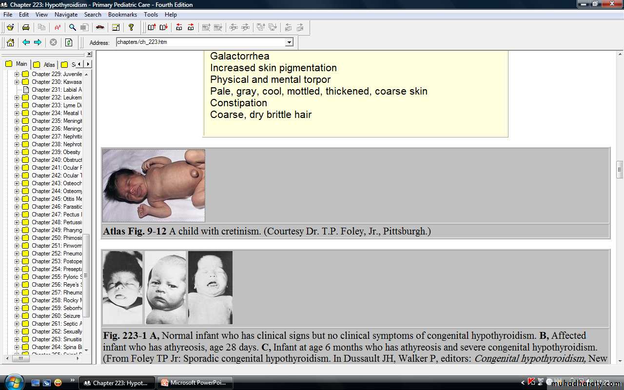 conjenital hypothyrodysm