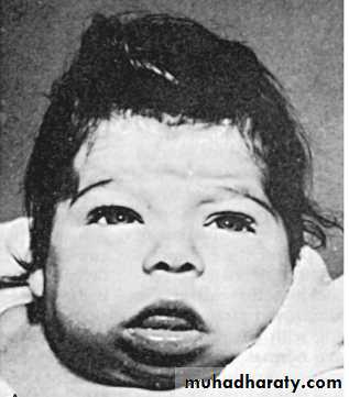 conjenital hypothyrodysm