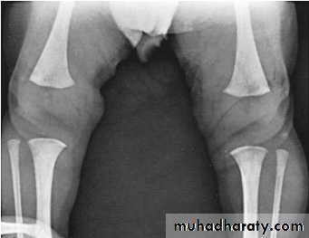 conjenital hypothyrodysm