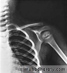 conjenital hypothyrodysm