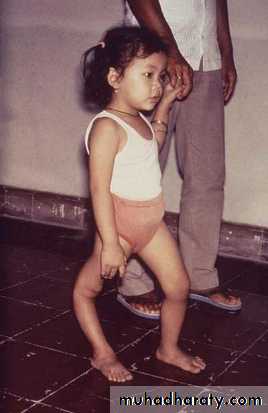 poliomyelitis