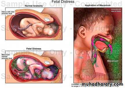 prolonged pregnancy