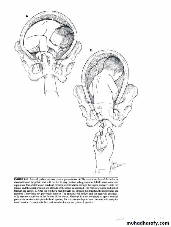 Multiple pregnancy