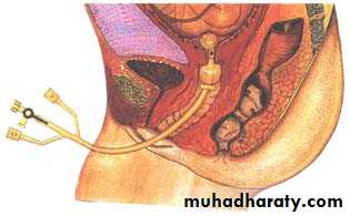 Induction of labour