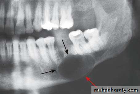 Cyst