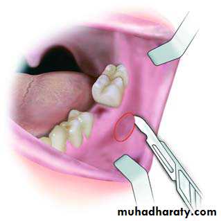 Cyst