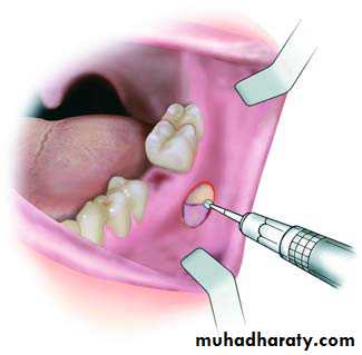 Cyst