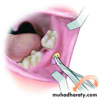 Cyst