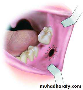 Cyst