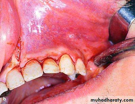 Cyst