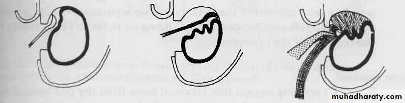 Cyst