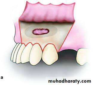 Cyst