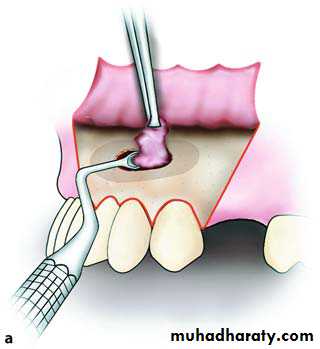 Cyst
