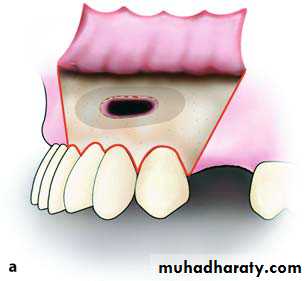 Cyst