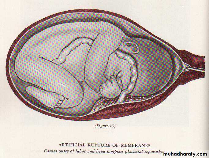 induction of labour