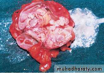 urinary tract infection2