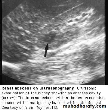 urinary tract infection2