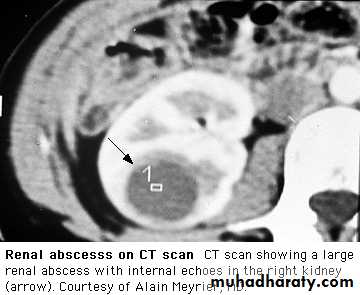 urinary tract infection2