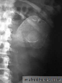 urinary tract infection2