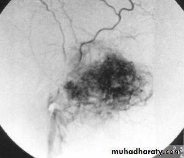 Tumors of Pharynx