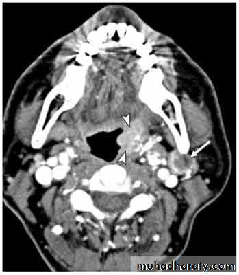 Tumors of Pharynx