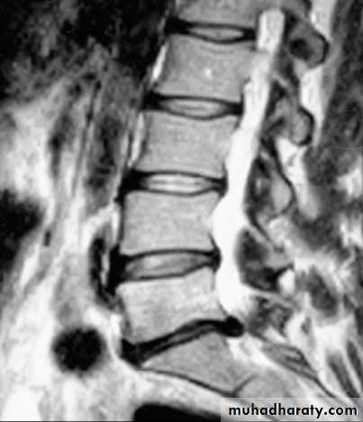 disease of spinal nerve