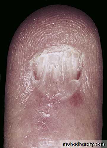 nail disease