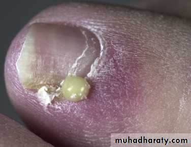 nail disease
