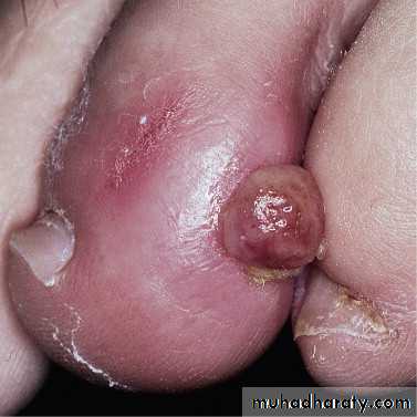 nail disease