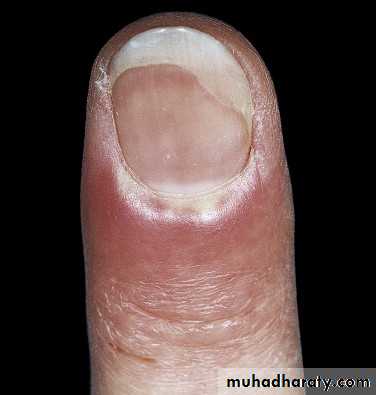 nail disease
