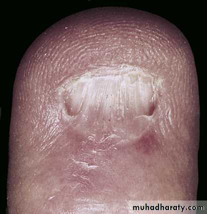 nail disease