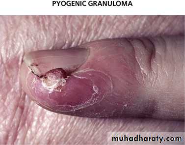 nail disease