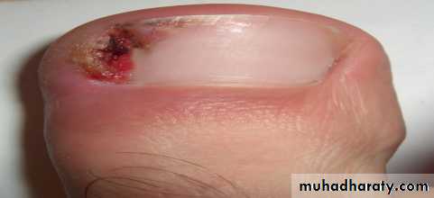 nail disease