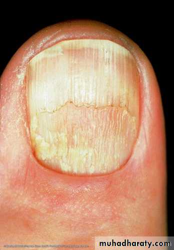 nail disease