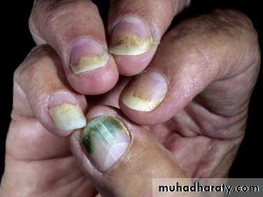 nail disease