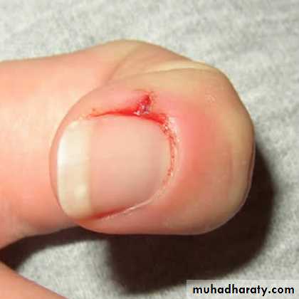 nail disease