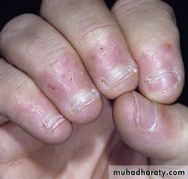 nail disease