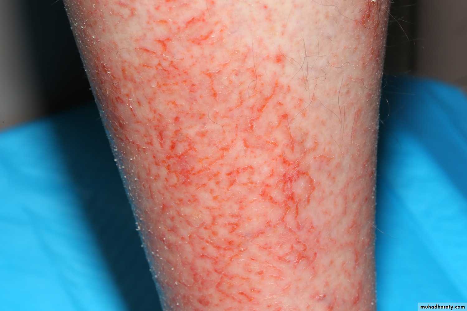 Dermatology sessions