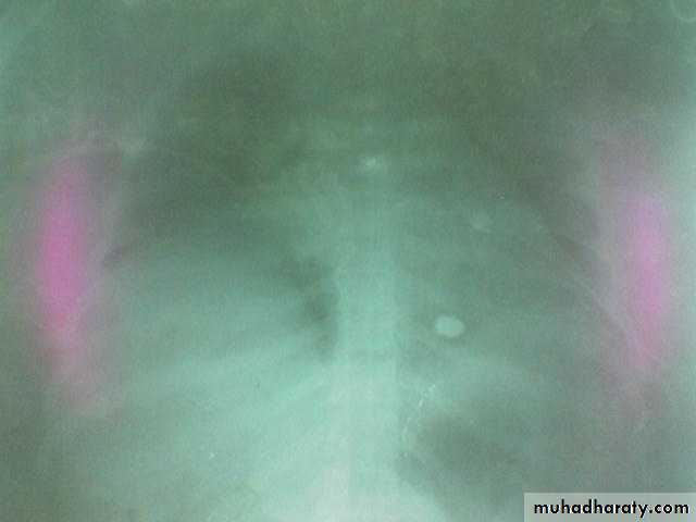 INTRA CARDIAC BULLET WITH INTRA VASCULAR PULMONARY EMBOLIZATION
