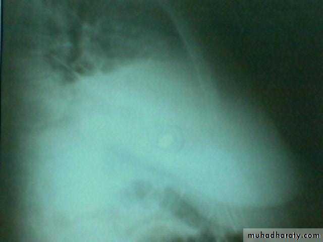 INTRA CARDIAC BULLET WITH INTRA VASCULAR PULMONARY EMBOLIZATION